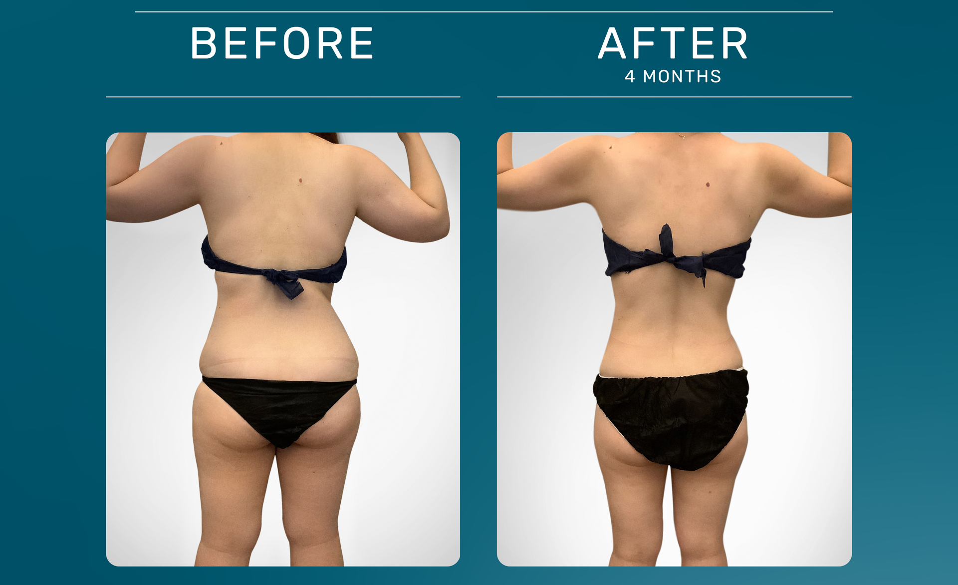 vorher nachher vergleich von kryolipolyse - links vorher und rechts nachher - behandelte Zone: HHüften